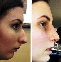 Before After Rhinoplasty For Large Nostrils In Tijuana Mexico at Cosmed Clinic