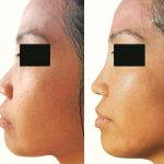 Before And After Asian Rhinoplasty In New Orleans