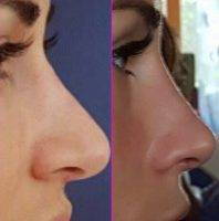 Before And After Cosmetic Surgery For Nose Photos