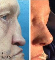 Before And After The Augmenting The Nasal Bridge
