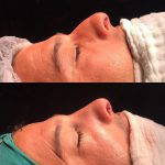 Before and after Removal of a dorsal hump (4)