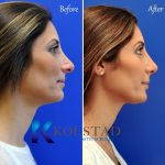 Bulbous Nose Before And After Nose Beaty Surgery (2)