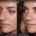 Bulbous Nose Before And After Nose Surgery (1)