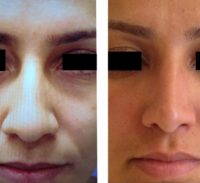 Bulbous Nose Can Be Corrected