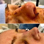 Bulbous Nose Plastic Surgery Pictures