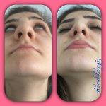 Bulbous Rhinoplasty Before And After (2)