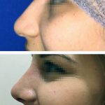 Cosmetic Nose Surgery In Louisiana Preop And Postop Photos