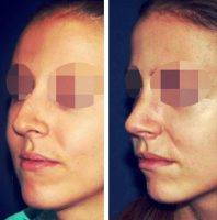 Cosmetic Surgery Nose In Minnesota Before And After
