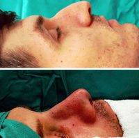 Cosmetic Surgery Nose Reshaping For Man Maryland Photos Before After
