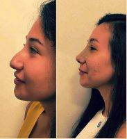 Dr. Taherian Iran Cosmetic Surgery Nose Preop And Postop