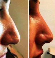 Free Nose Surgery Before And After Photo