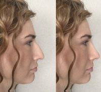 Free Rhinoplasty Surgery Due To Online Fundraising For Surgery
