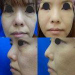 Image Of Korean Nose Tip Surgery