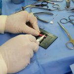Implants For Rhinoplasty