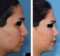 Iran Is Known As The Rhinoplasty Capital Of The World