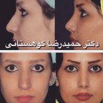 Iranian Hooked Nose