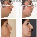 Iranian Nose Job Pictures (1)