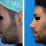 Iranian Nose Job Pictures (5)