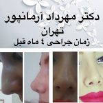 Iranian Nose Job Pictures (6)