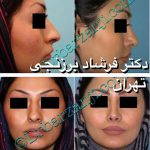 Iranian Nose Job Pictures (8)