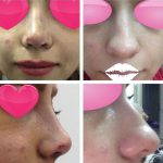 Iranian Nose Operation Before And After (1)