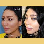Iranian Nose Plastic Surgery Before And After (1)