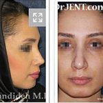 Iranian Nose Plastic Surgery Before And After (3)