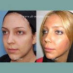Iranian Nose Plastic Surgery Before And After (4)