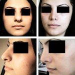 Iranian Nose Shape Pictures (1)