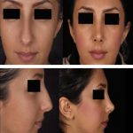 Iranian Nose Shape Pictures (3)