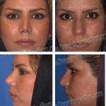 Iranian Nose Shape Pictures (4)