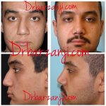Iranian Nose Surgery Before And After (3)