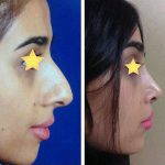 Iranian Nose Surgery Before And After (4)