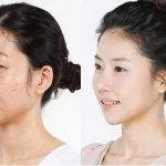 Korean Flat Nose Surgery Before After (2)