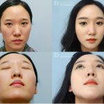 Korean Girl Nose Surgery