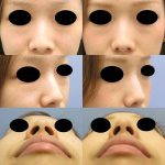 Korean Nose Augmentation Photos Before And After (3)