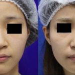 Korean Nose Before And After (4)