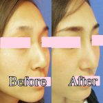 Korean Nose Job Before And After Pictures (1)