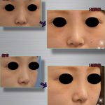 Korean Nose Reshaping Before After