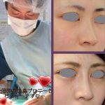 Korean Nose Surgery Images (3)