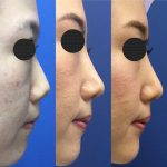 Korean Rhinoplasty Before And After Photos (1)