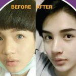 Korean Rhinoplasty Before And After Photos (6)