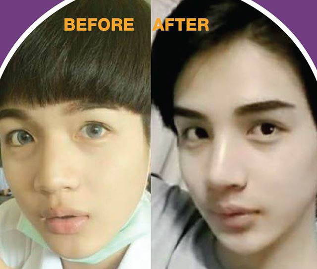 Korean Rhinoplasty Before And After Photos (6) » Rhinoplasty Cost, Pics, Reviews, Q&A