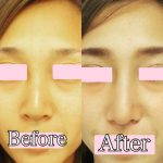 Korean Rhinoplasty Before And After Pictures (2)