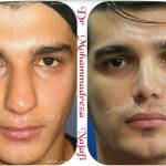 Male Bulbous Nose Before And After Nose Surgery