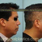 Male Korean Rhinoplasty Before And After Pictures (2)