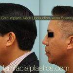 Male Korean Rhinoplasty Before And After Pictures (3)