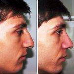 Male Nasal Reconstruction Surgery In Mumbai