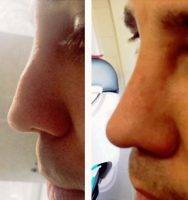 Maryland Male Nose Job Before And After Photo