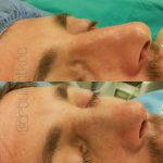 Most Crooked Noses Can Be Effectively Repaired By Surgical Reconstruction